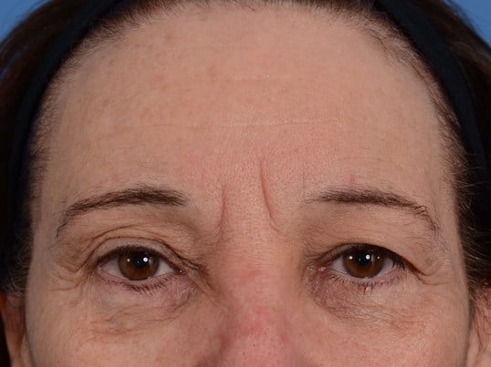 Upper Eyelid Lift Before