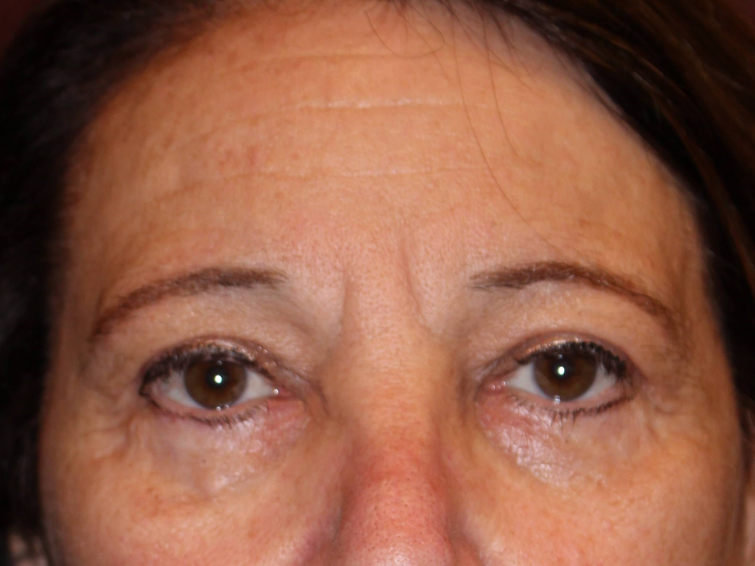 Upper Eyelid Lift After