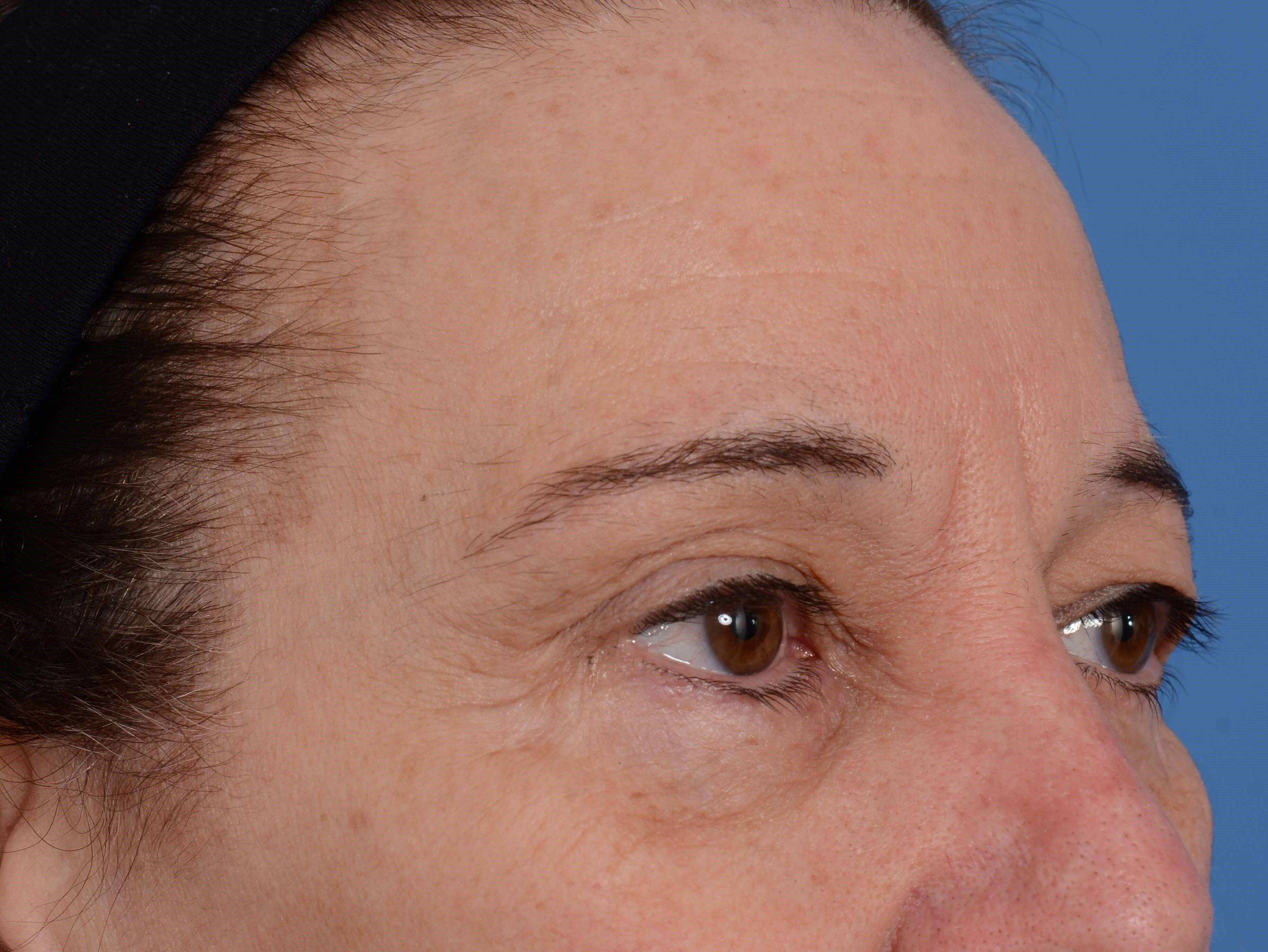 Upper Eyelid Lift Before