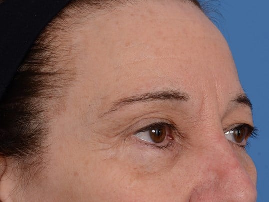 Upper Eyelid Lift Before