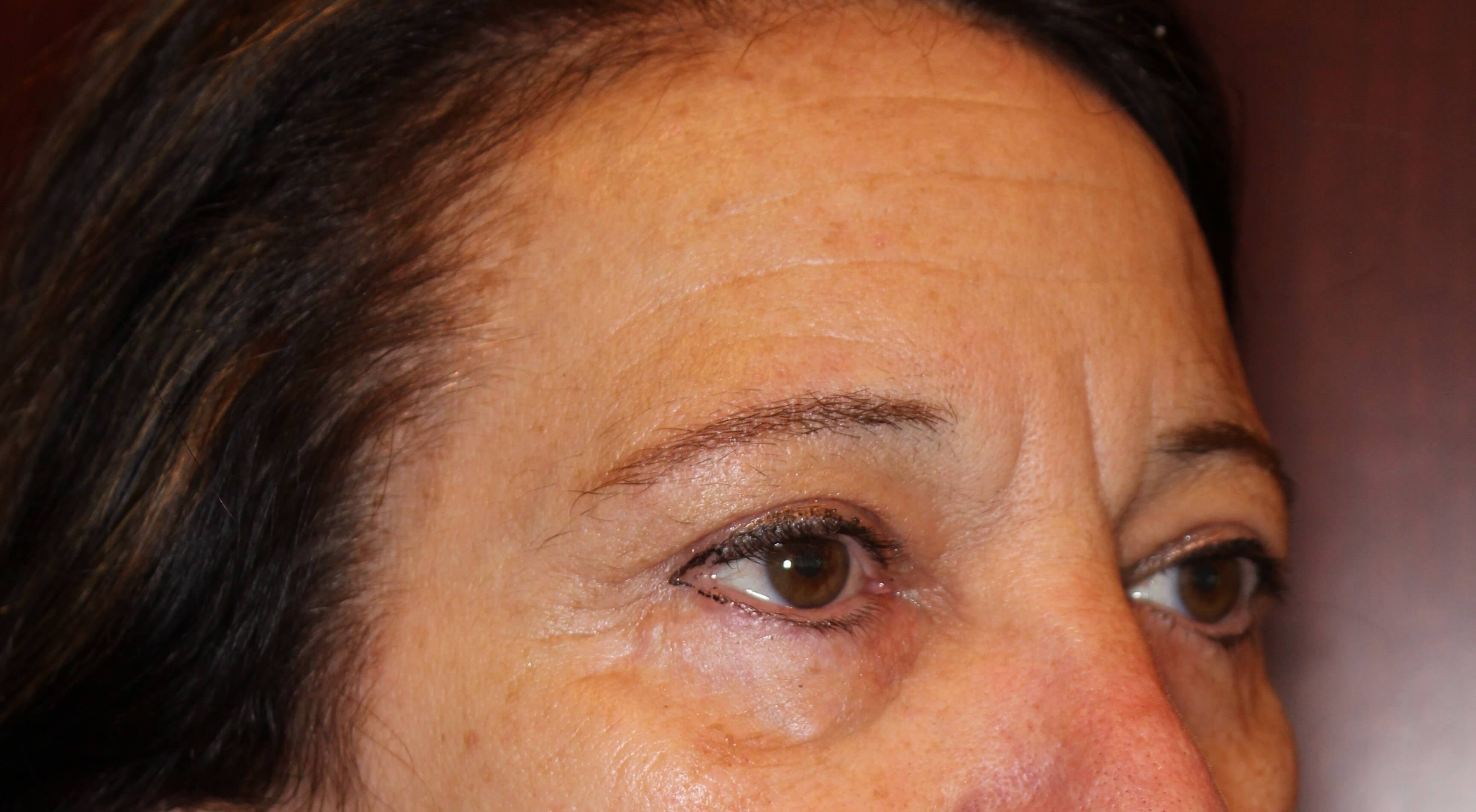 Upper Eyelid Lift After