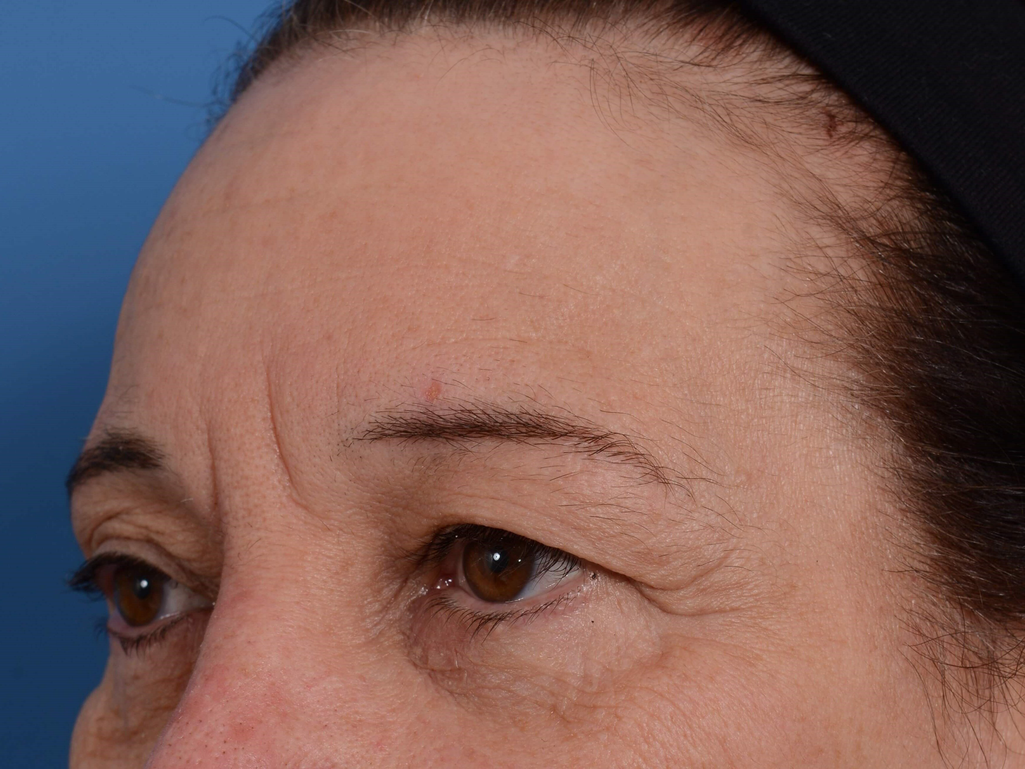 Upper Eyelid Lift Before