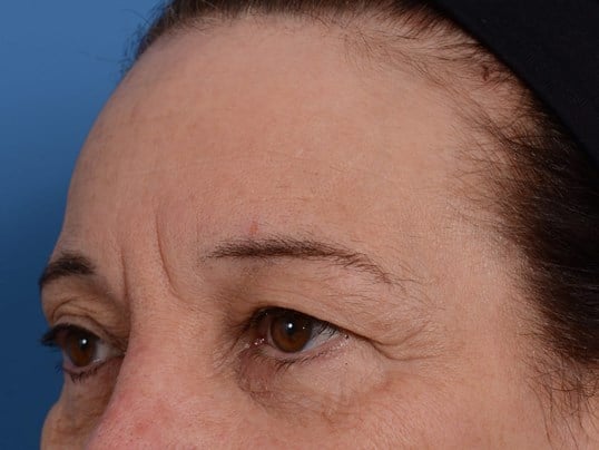 Upper Eyelid Lift Before