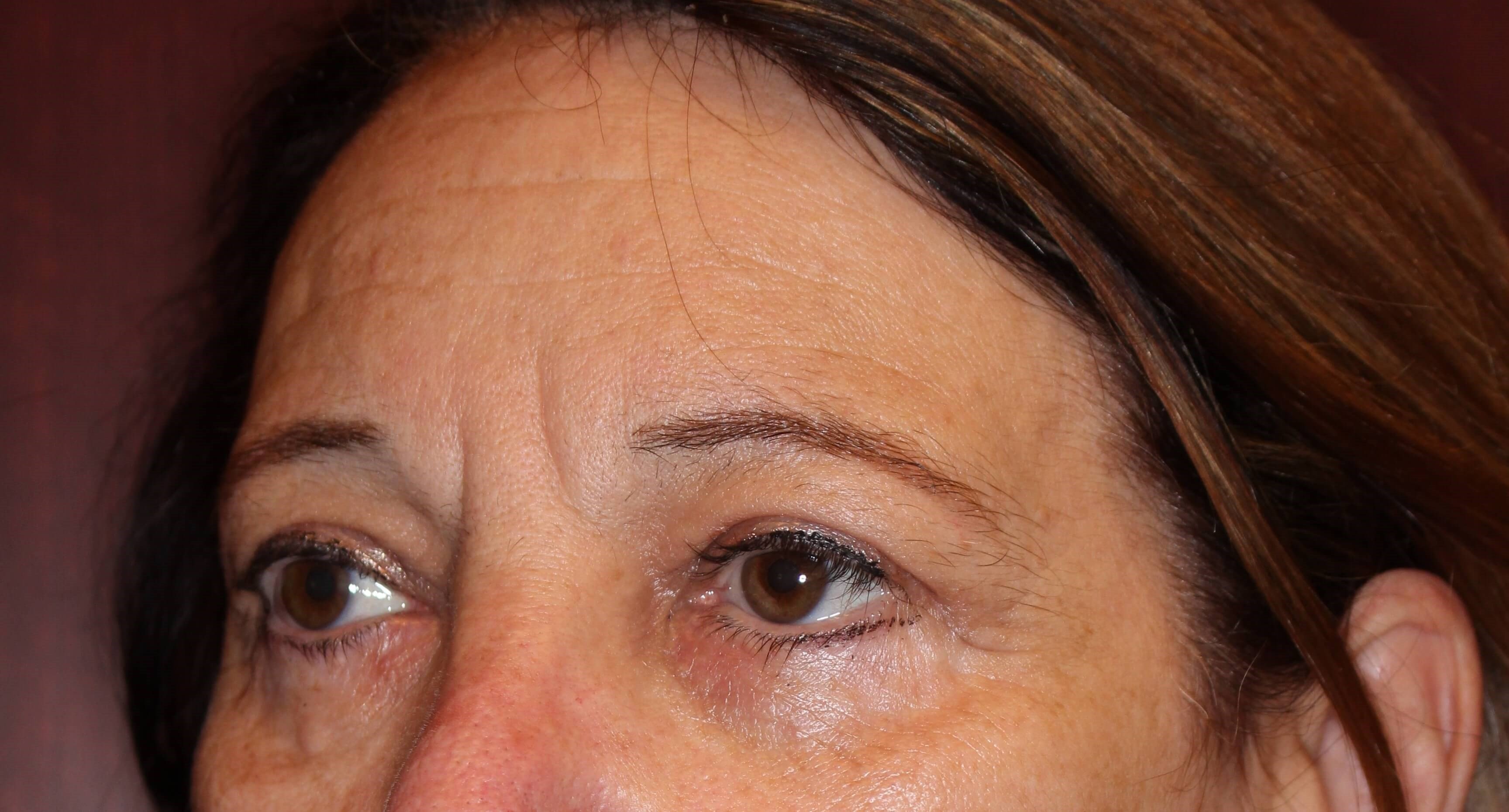 Upper Eyelid Lift After