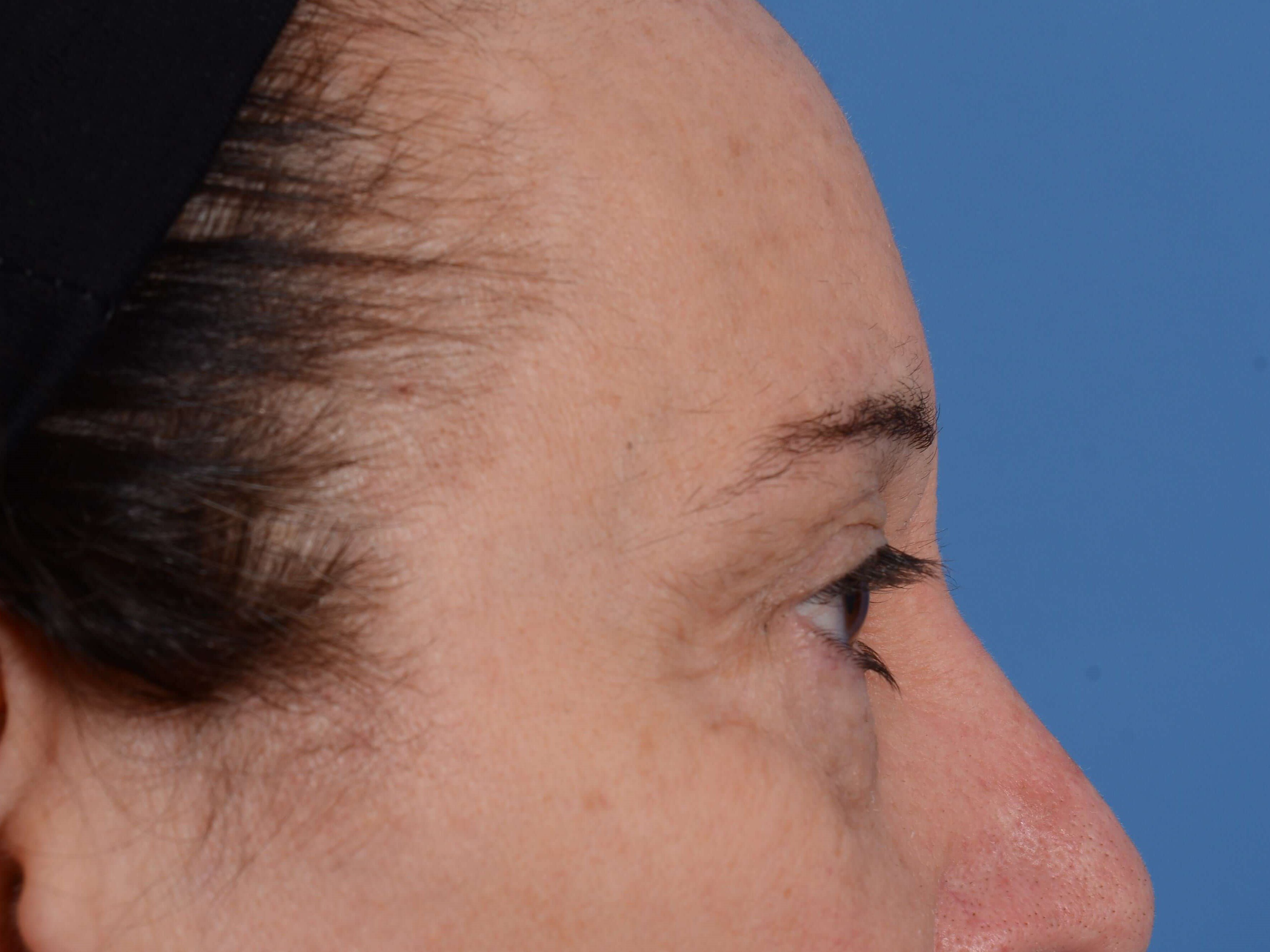 Upper Eyelid Lift Before