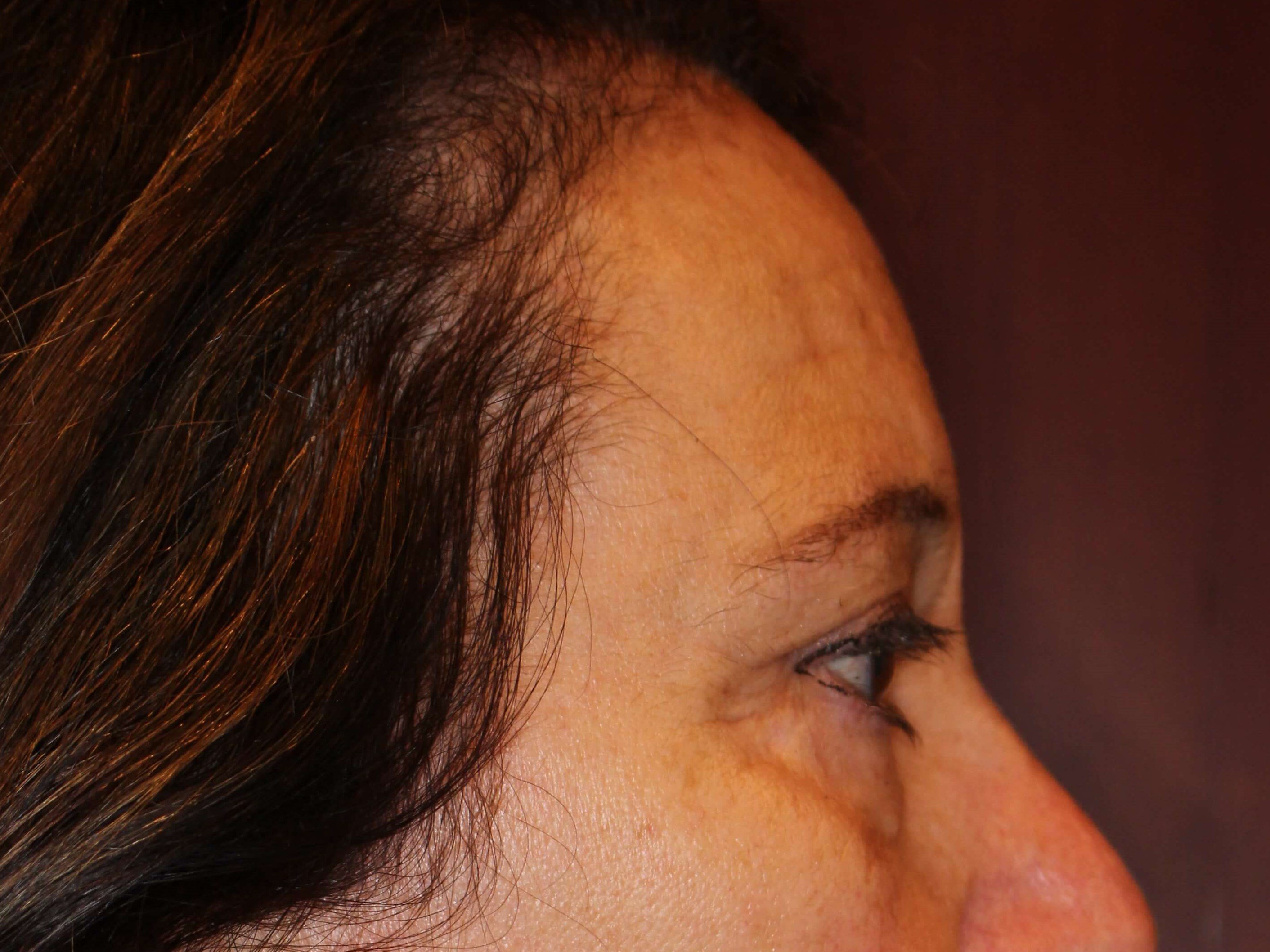 Upper Eyelid Lift After