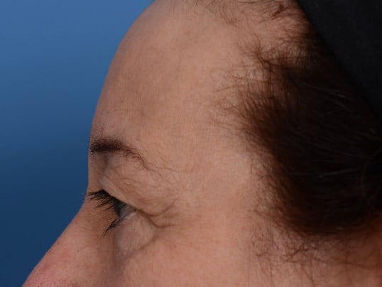 Upper Eyelid Lift Before