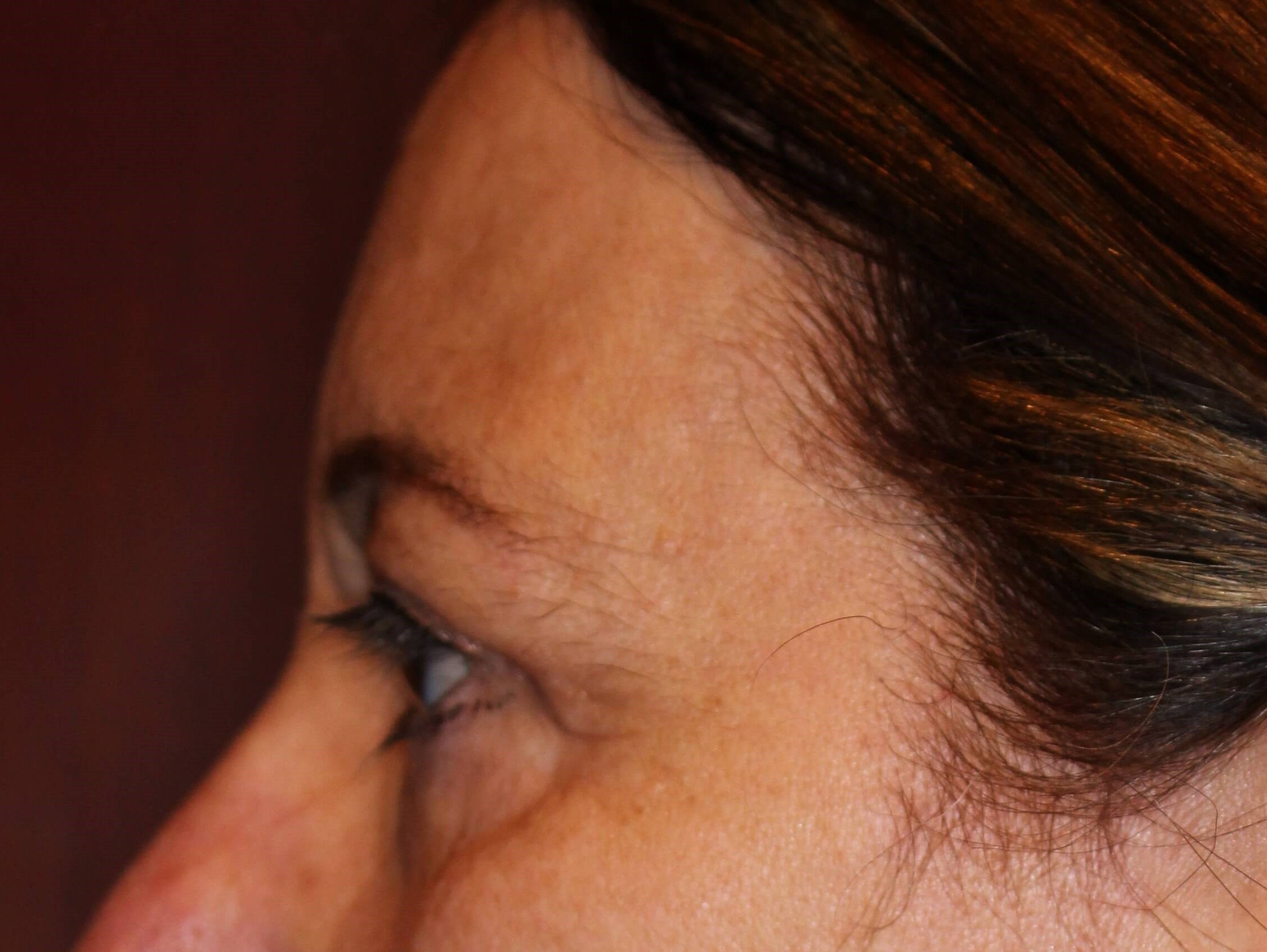 Upper Eyelid Lift After