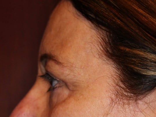 Upper Eyelid Lift After