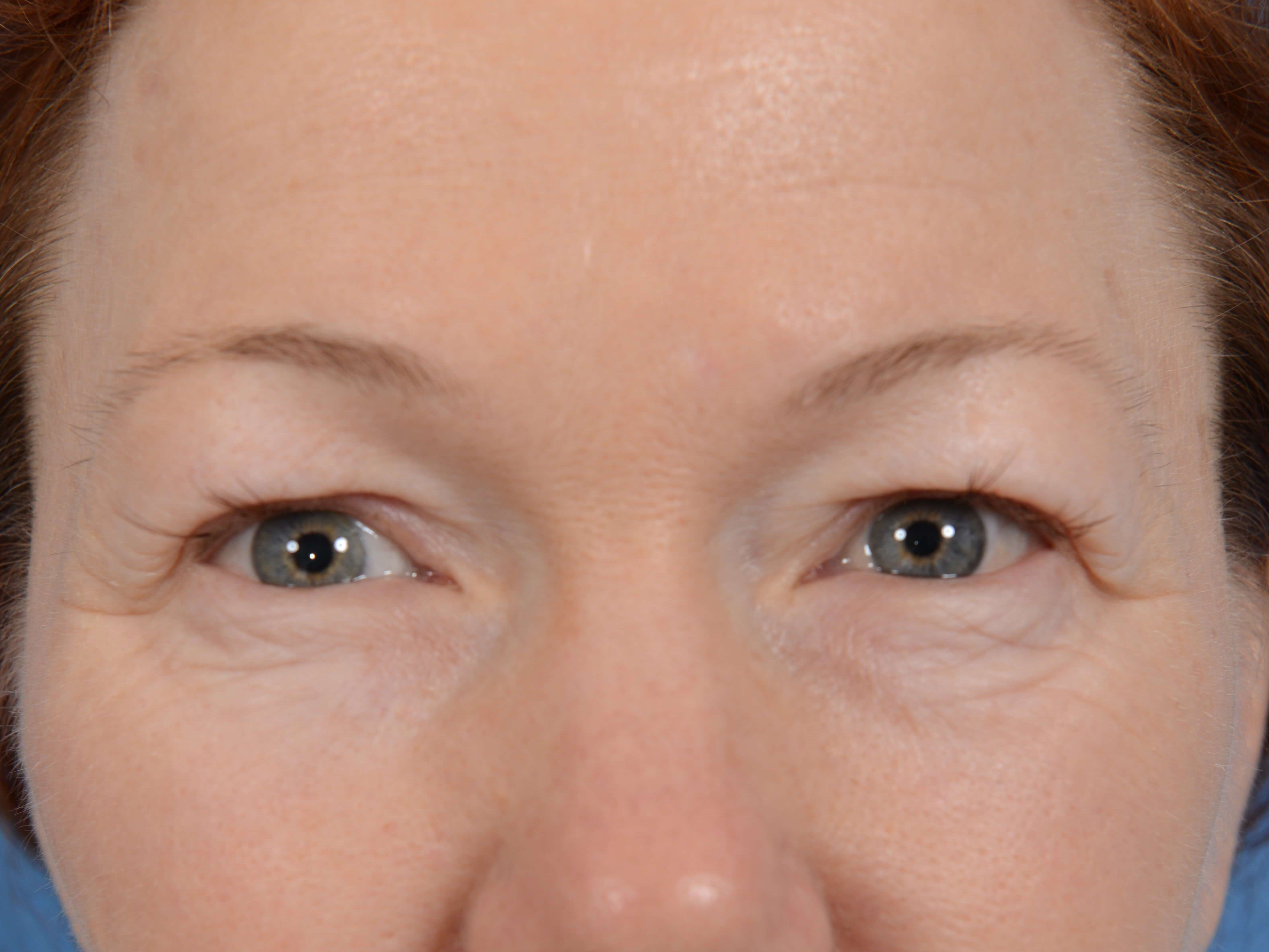 Upper Eyelid Lift Before