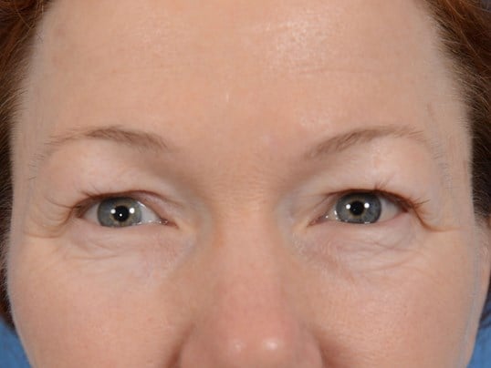 Upper Eyelid Lift Before