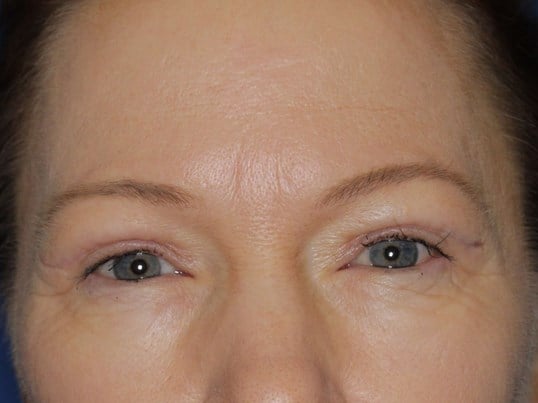 Upper Eyelid Lift After