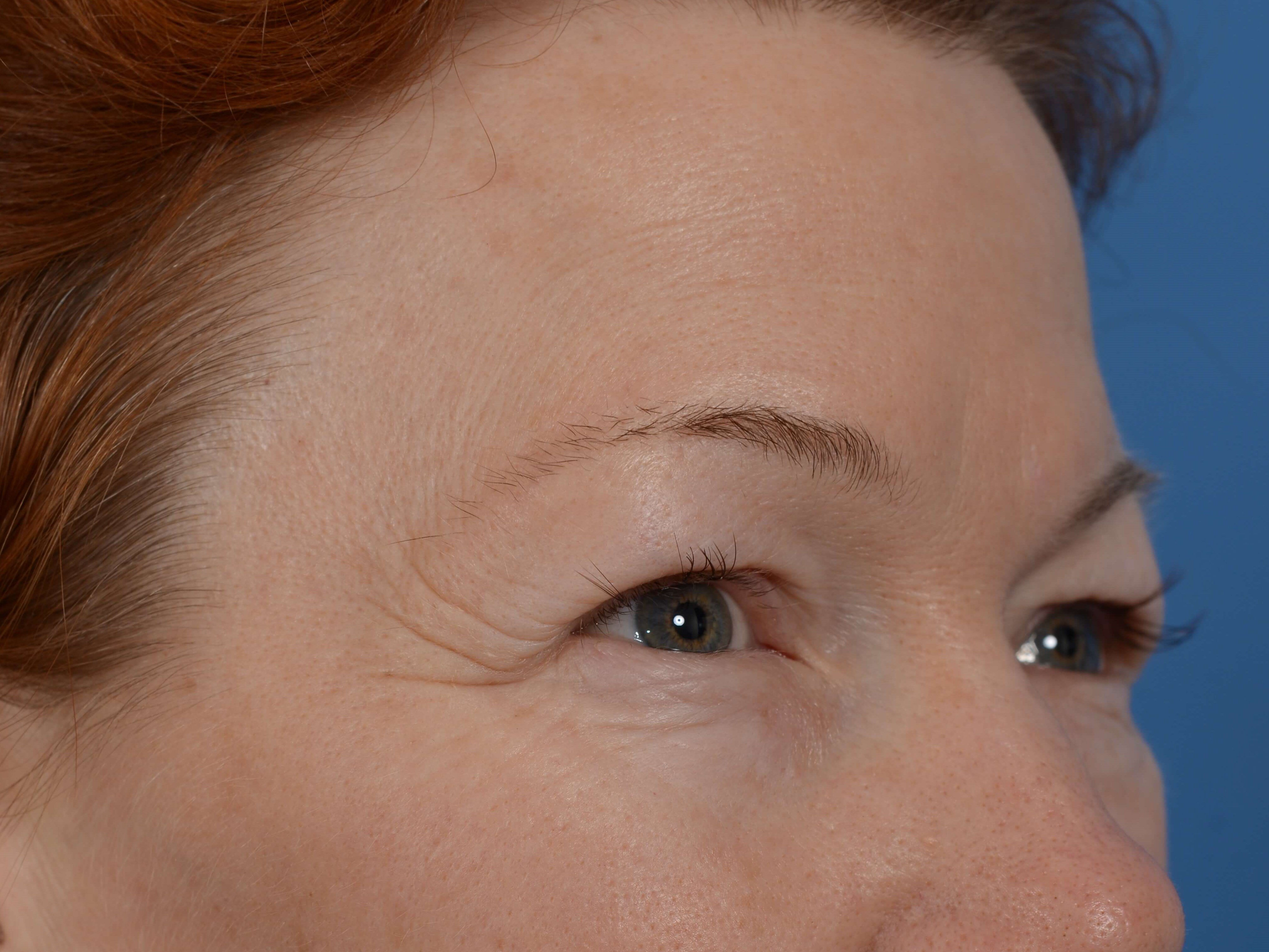 Upper Eyelid Lift Before