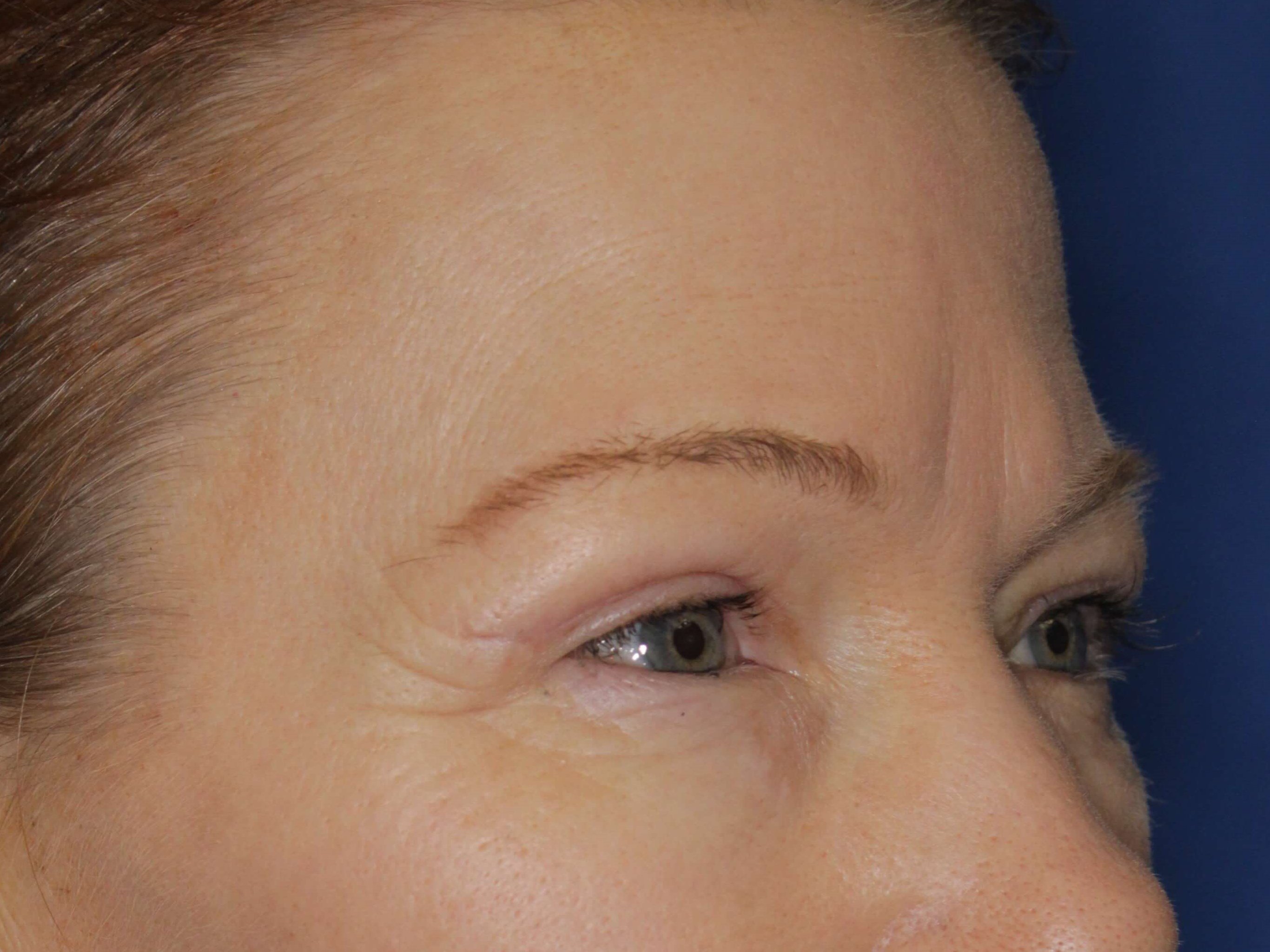 Upper Eyelid Lift After