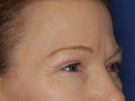 Upper Eyelid Lift After