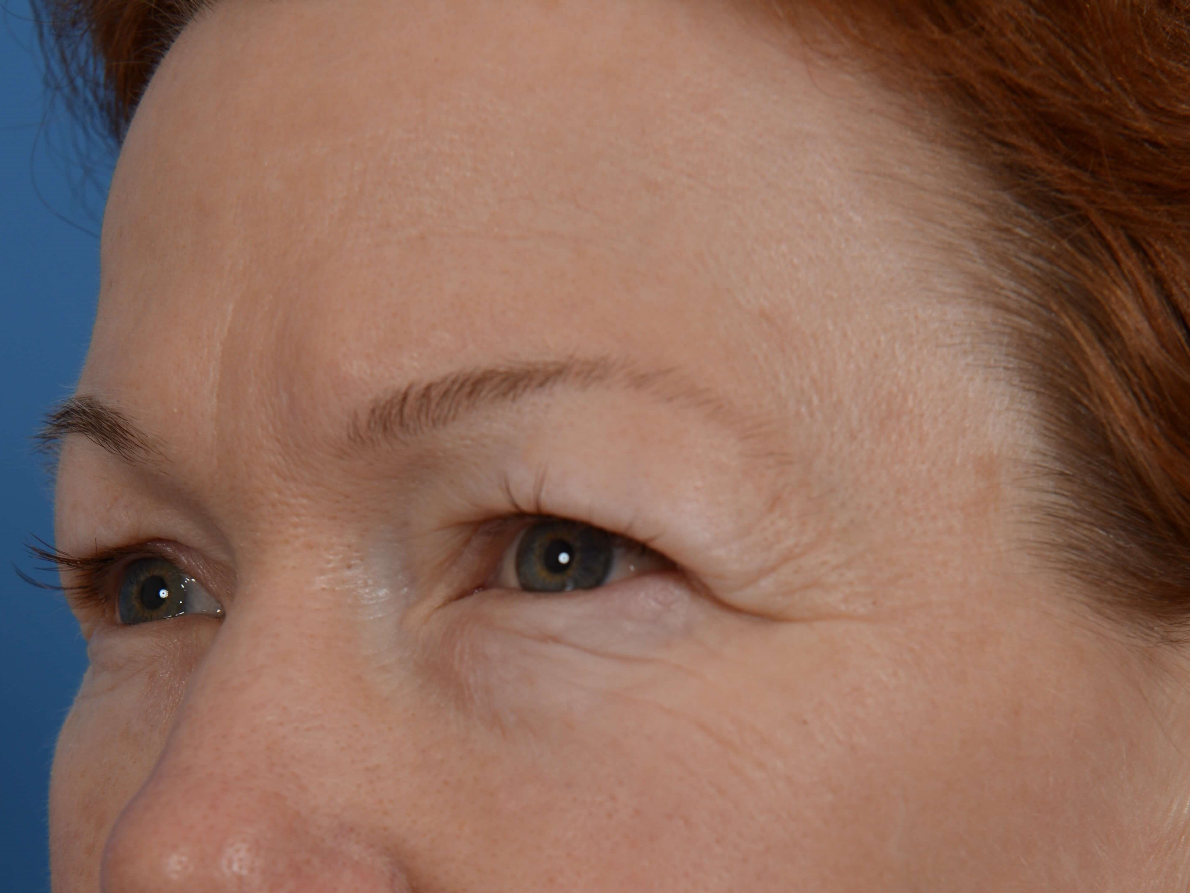 Upper Eyelid Lift Before