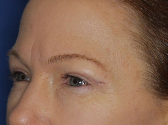 Upper Eyelid Lift After