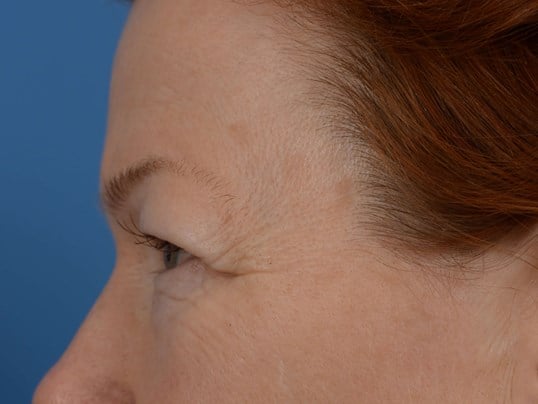 Upper Eyelid Lift Before