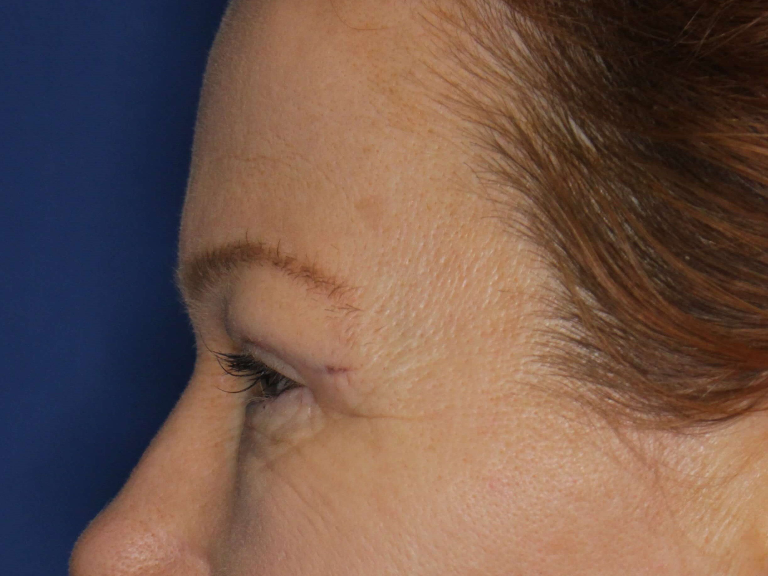 Upper Eyelid Lift After
