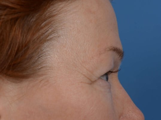 Upper Eyelid Lift Before