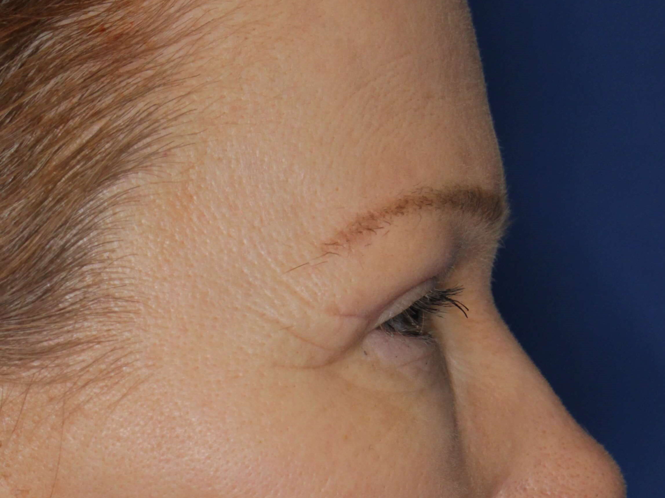 Upper Eyelid Lift After