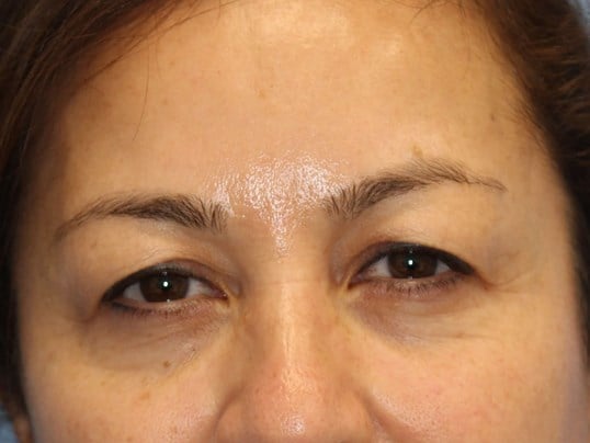 Upper Eyelid Lift Before