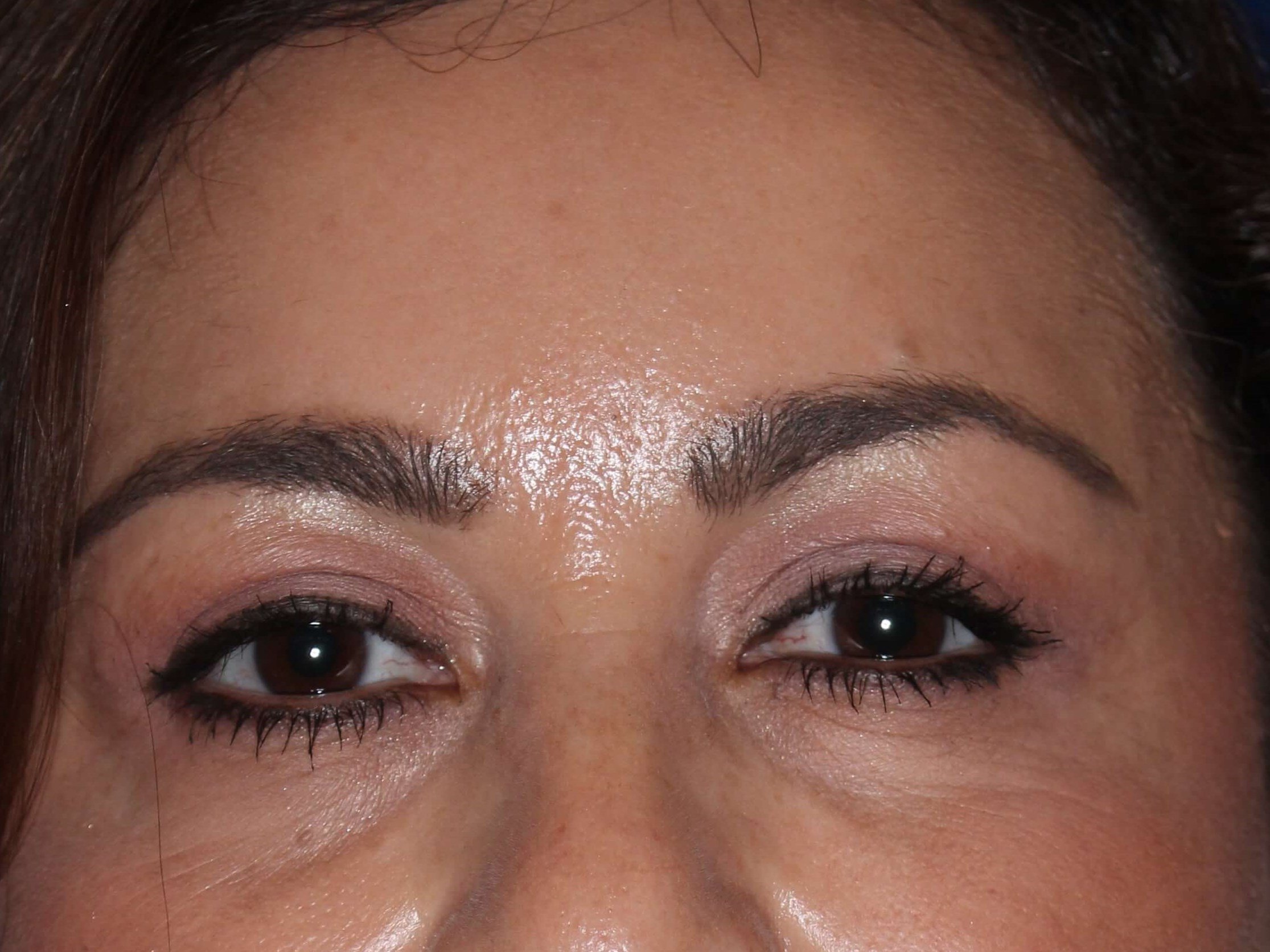 Upper Eyelid Lift After