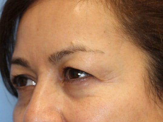 Upper Eyelid Lift Before