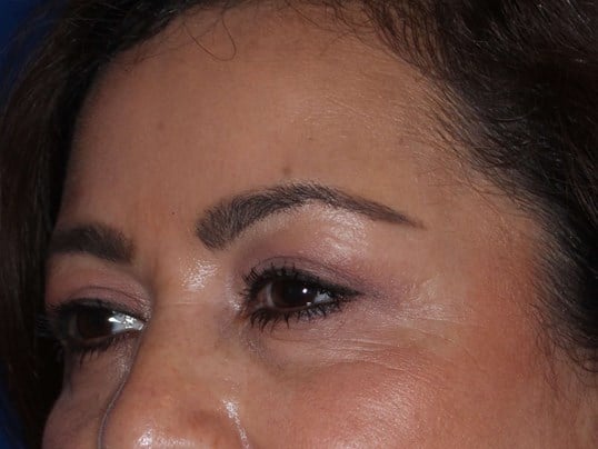 Upper Eyelid Lift After