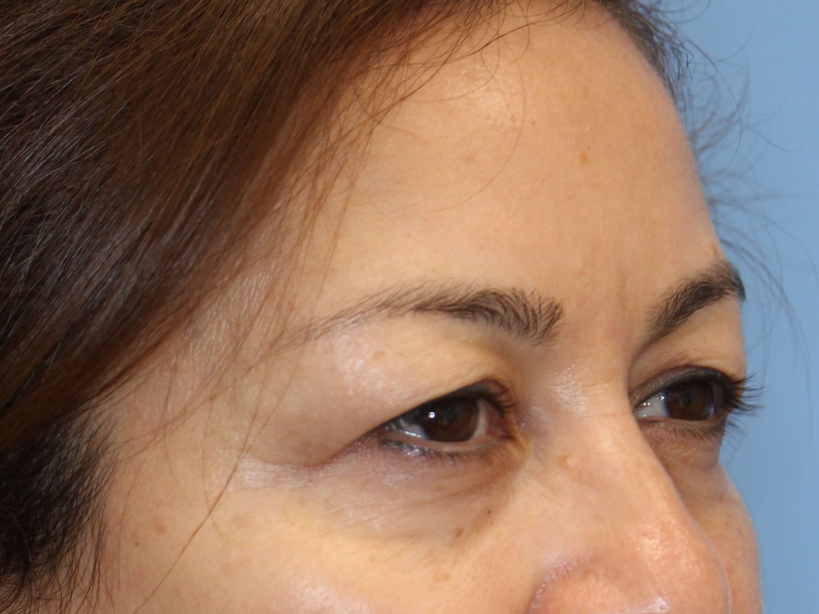 Upper Eyelid Lift Before