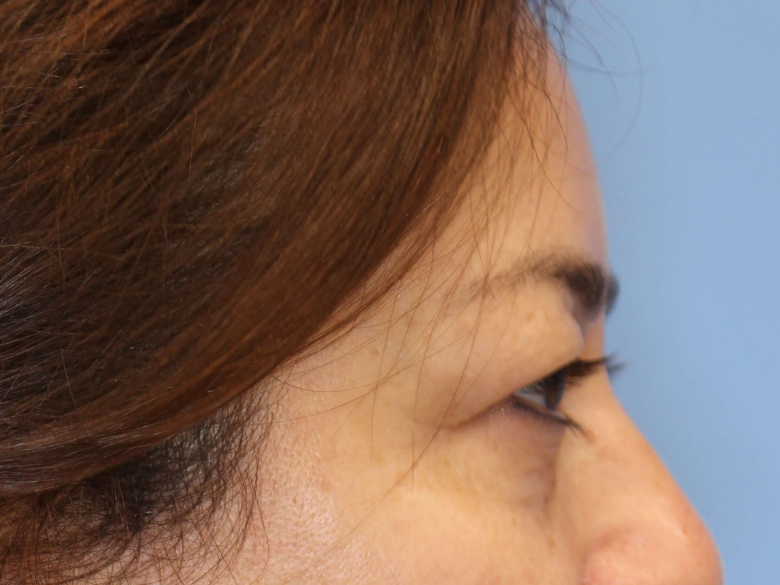Upper Eyelid Lift Before