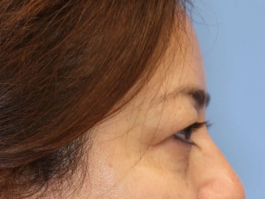 Upper Eyelid Lift Before