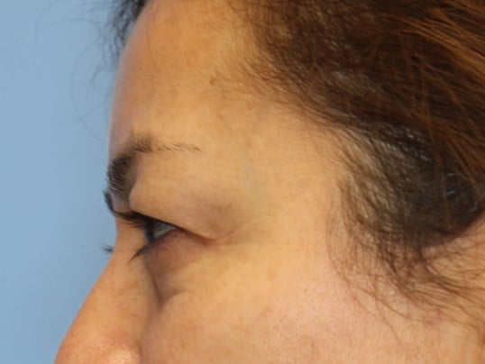 Upper Eyelid Lift Before