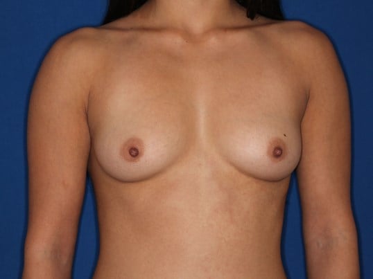 245 cc Silicone Implants, Before