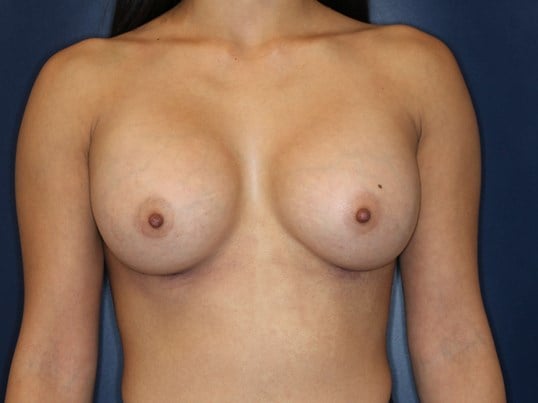 245 cc Silicone Implants, After