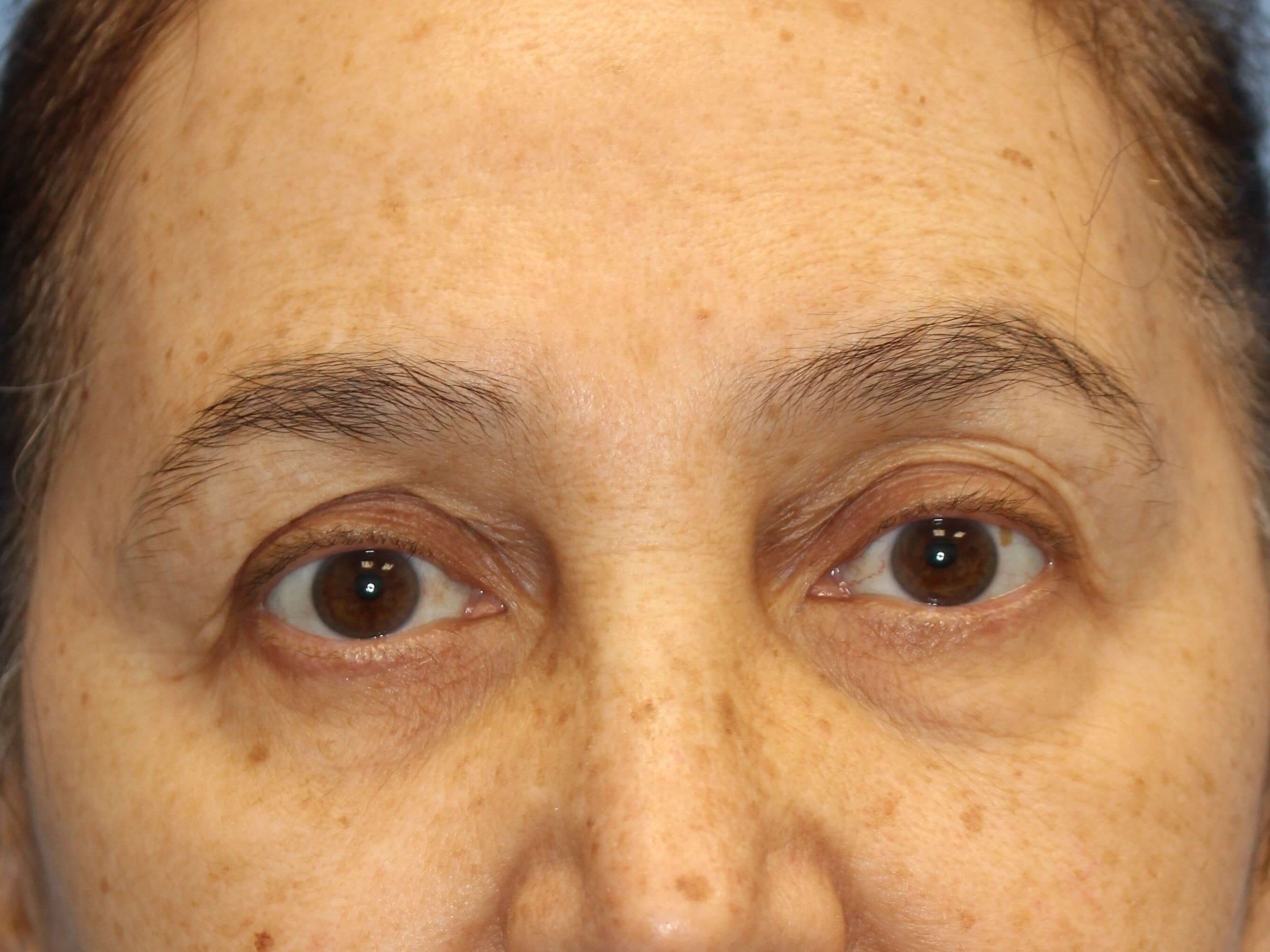 Brow Lift & Fat Injection Before