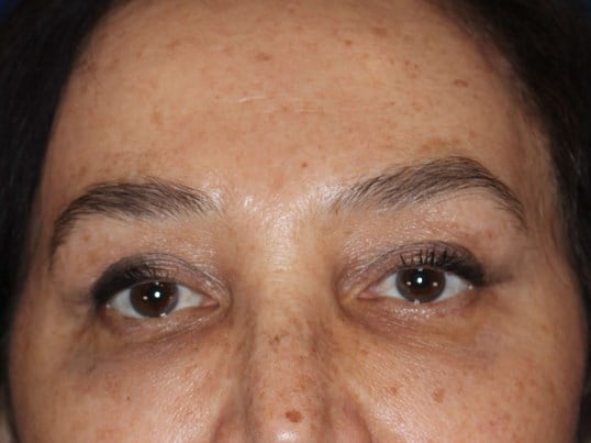 Brow Lift & Fat Injection After
