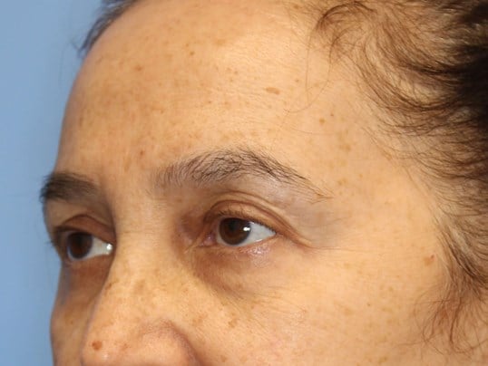 Brow Lift & Fat Injection Before