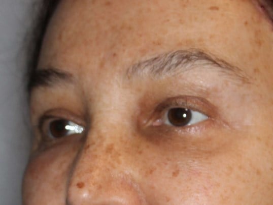 Brow Lift & Fat Injection After