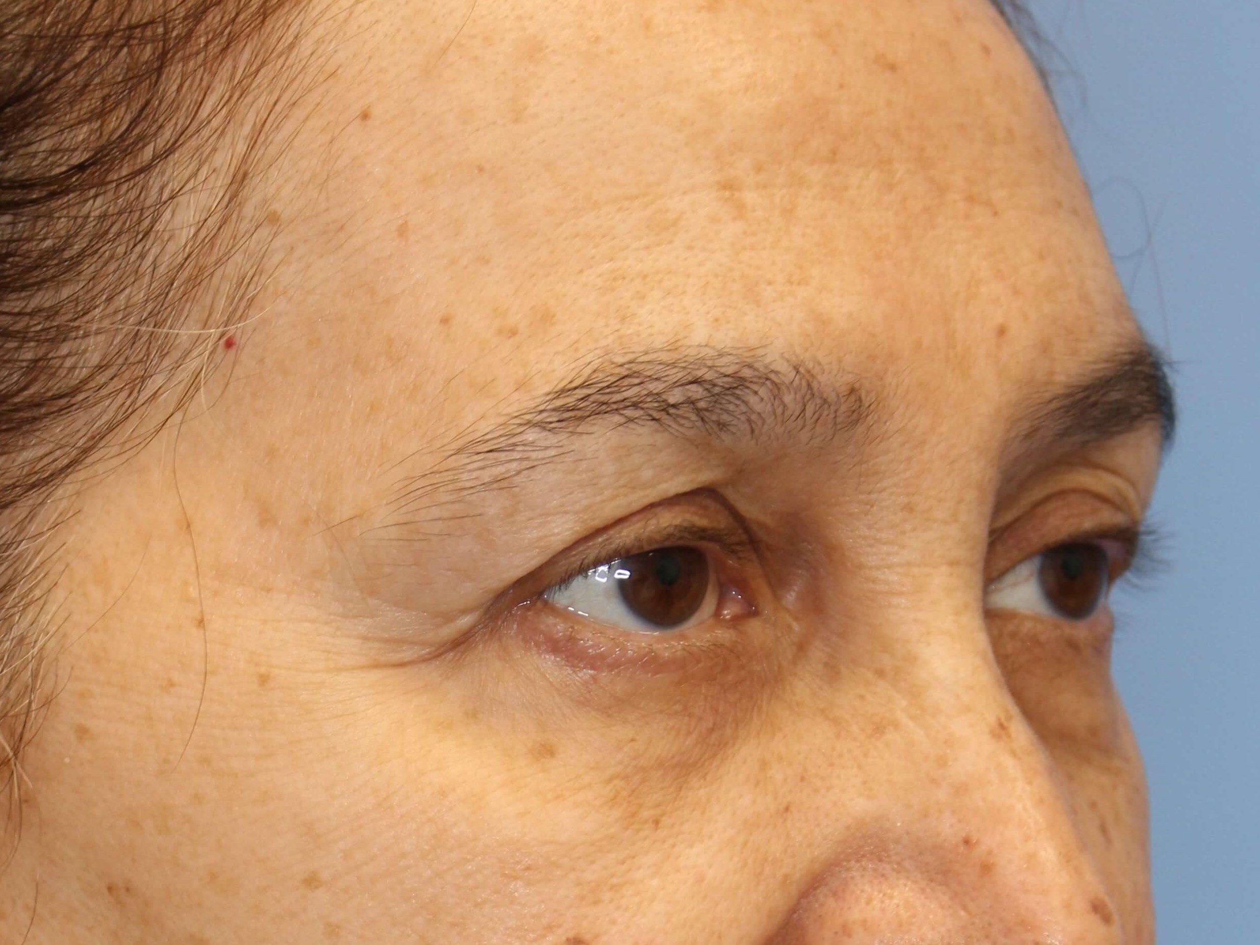 Brow Lift & Fat Injection Before