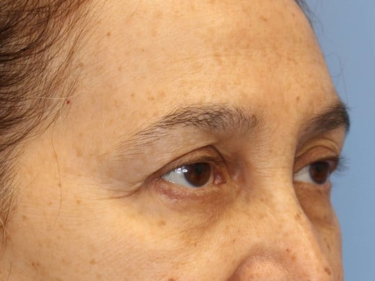 Brow Lift & Fat Injection Before