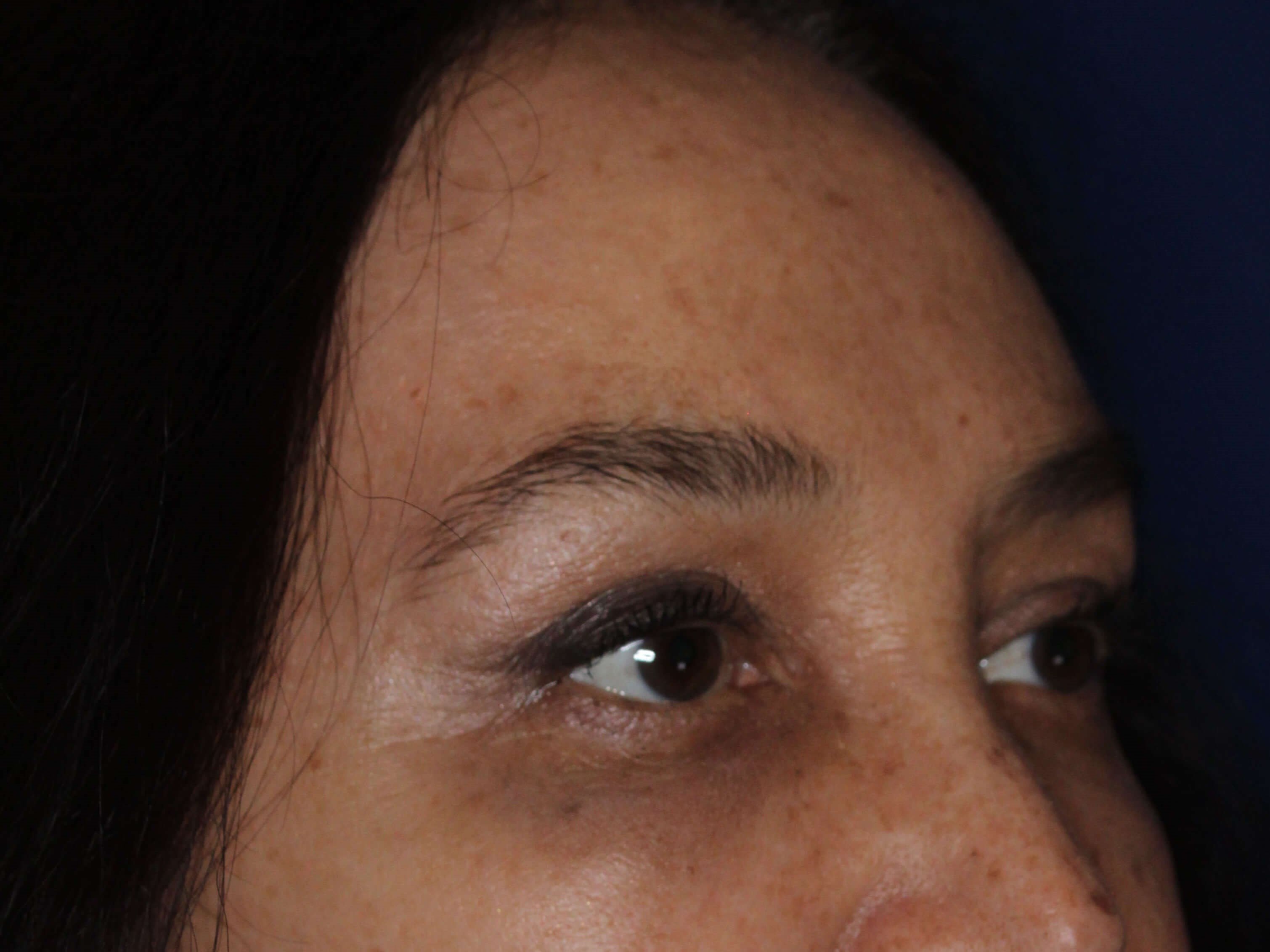 Brow Lift & Fat Injection After