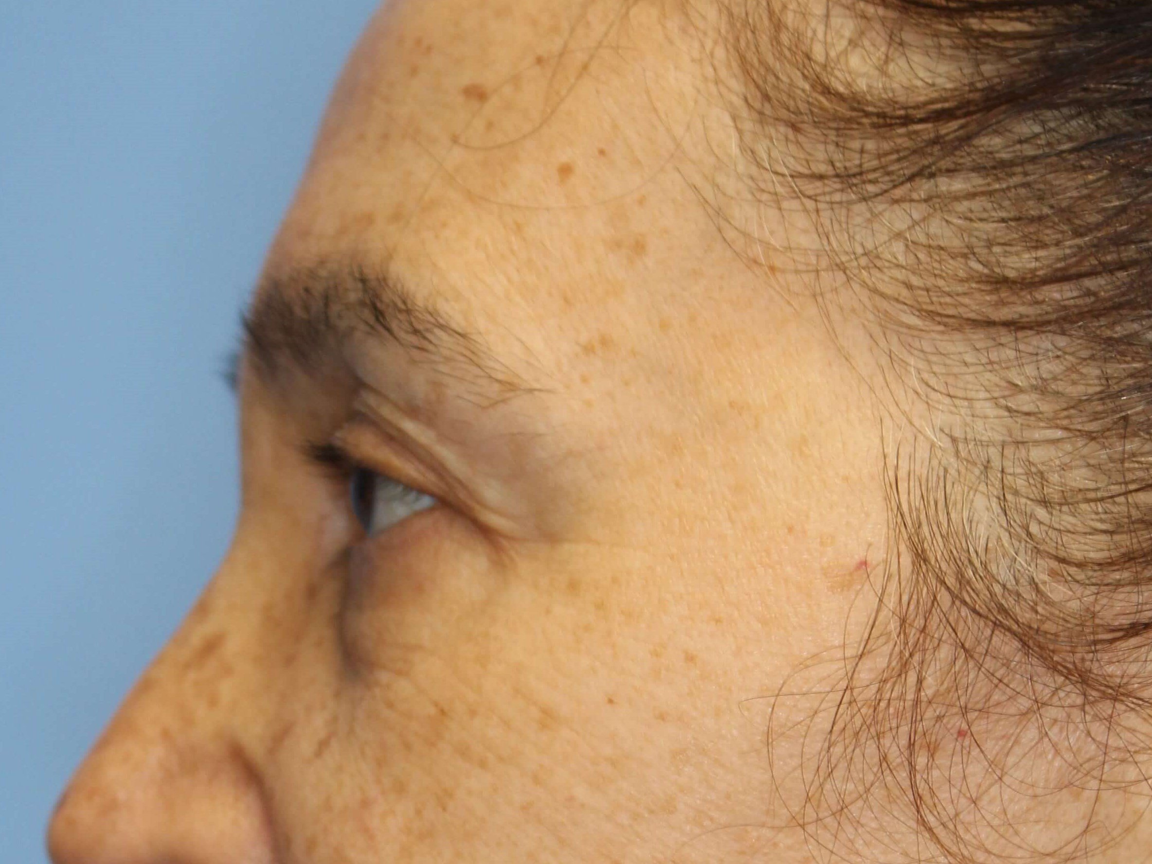 Brow Lift & Fat Injection Before