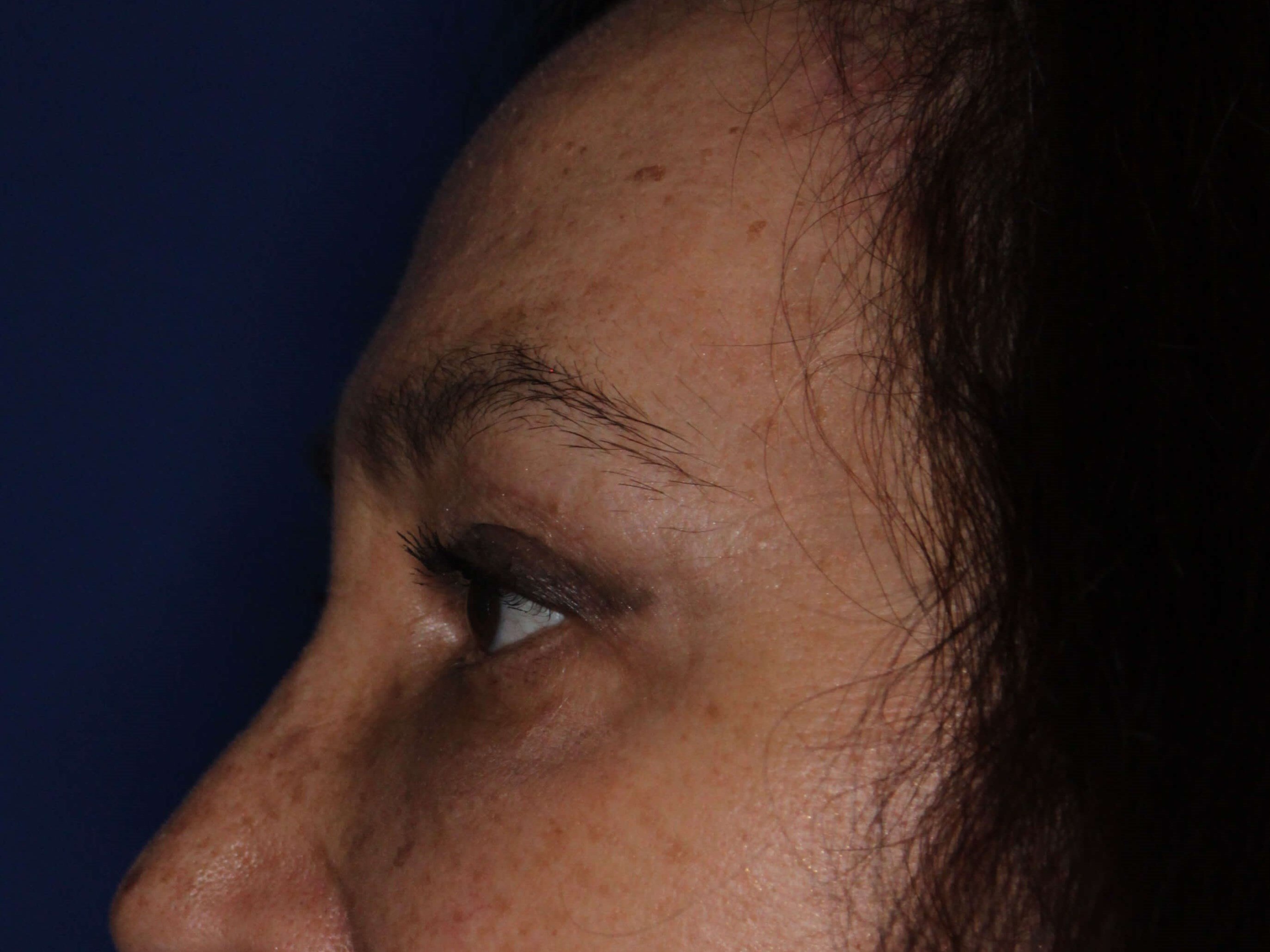 Brow Lift & Fat Injection After