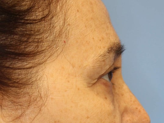 Brow Lift & Fat Injection Before