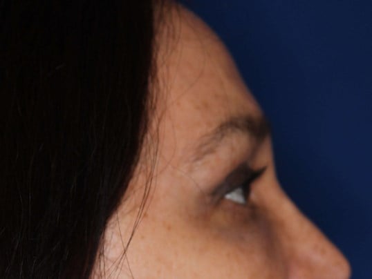 Brow Lift & Fat Injection After