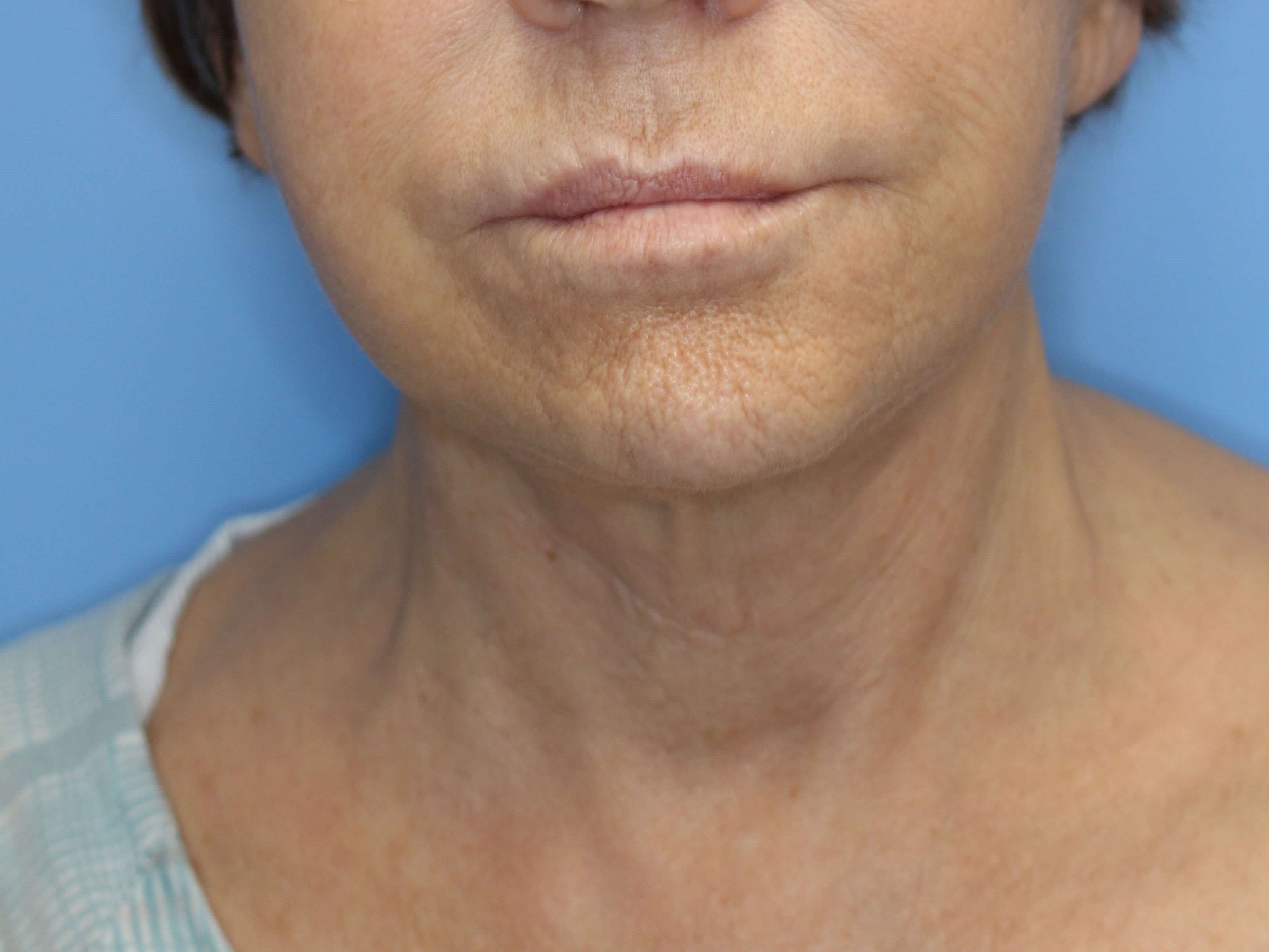 Secondary Neck Lift Before