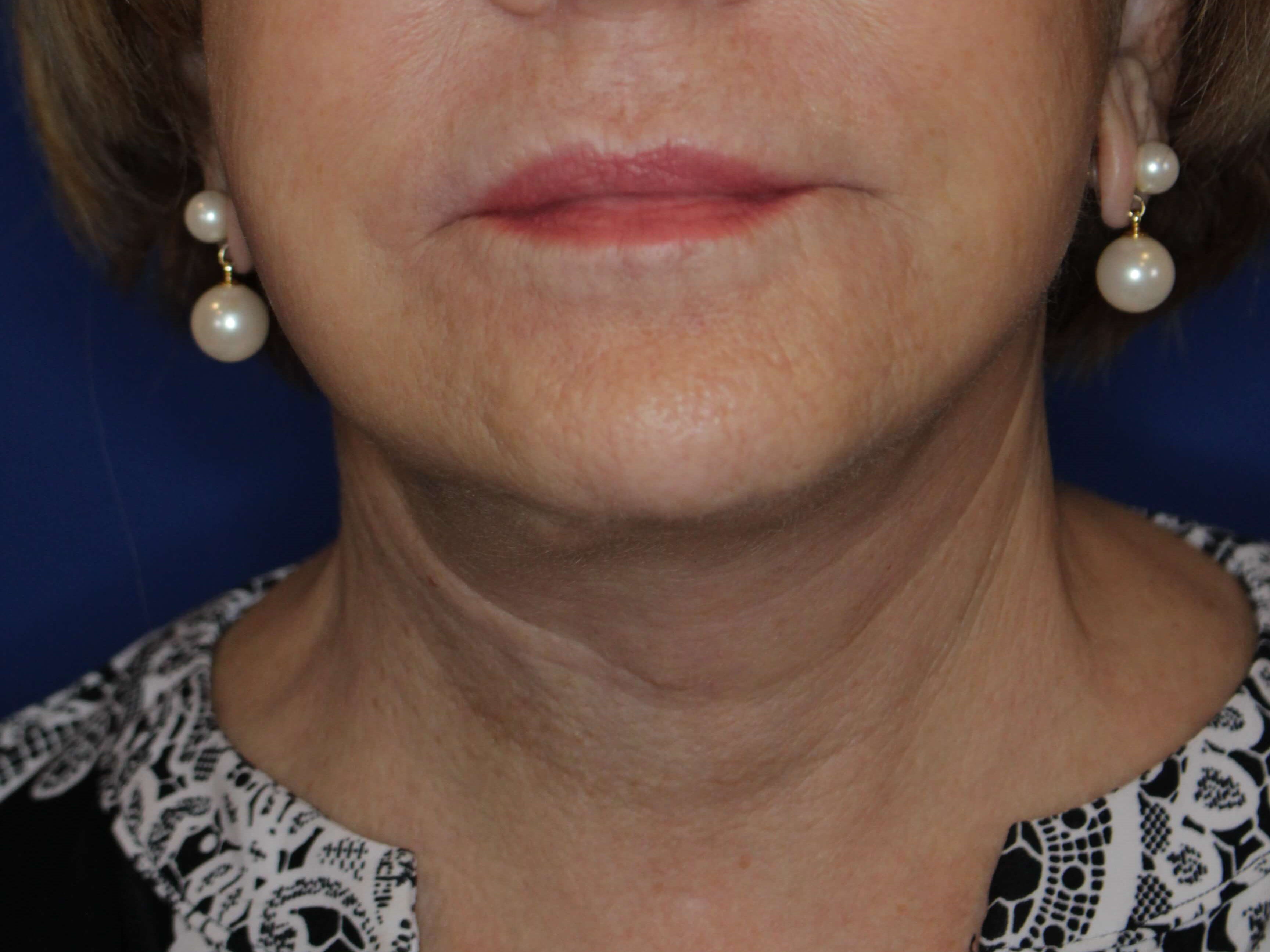 Secondary Neck Lift After