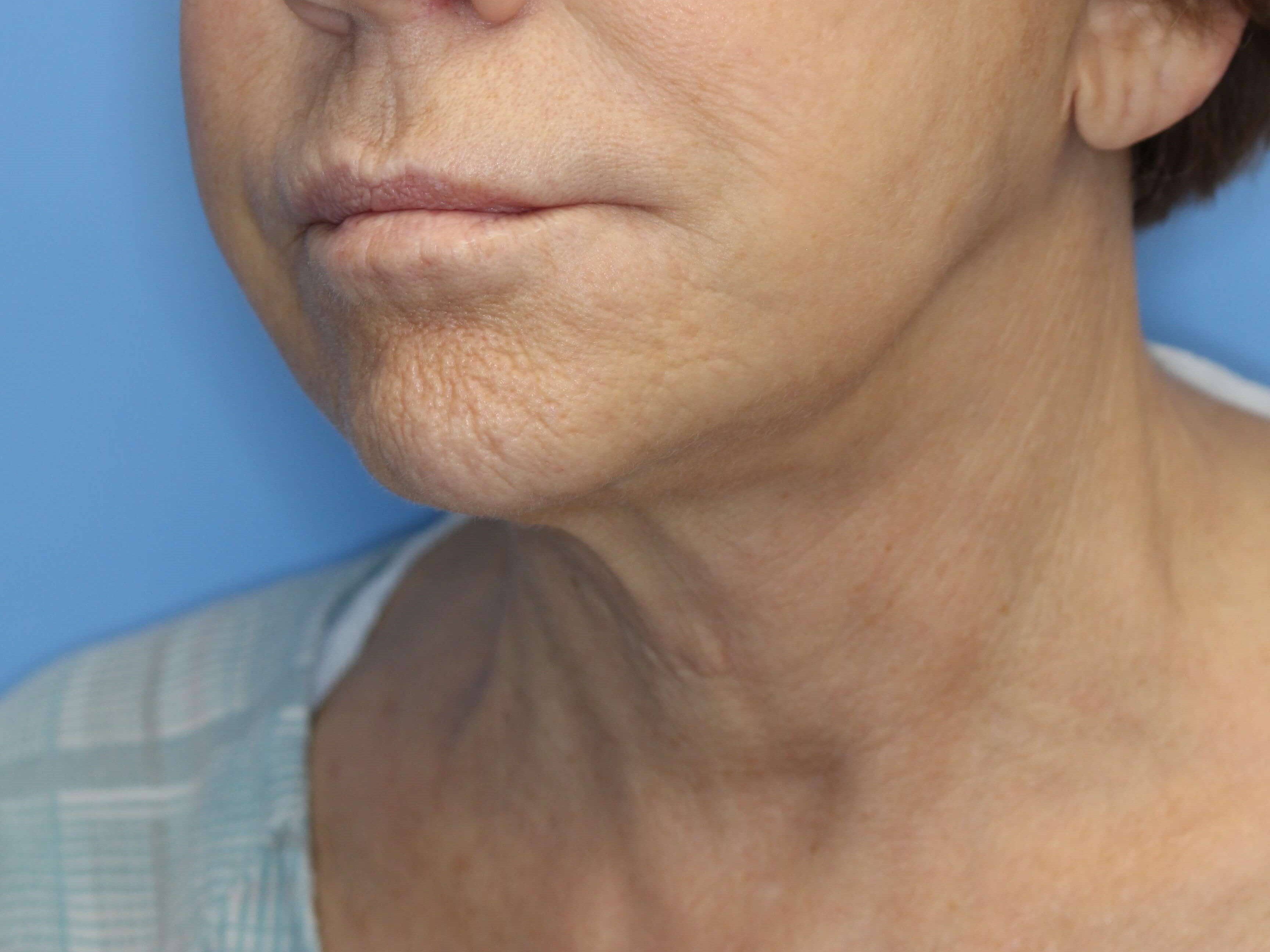 Secondary Neck Lift Before