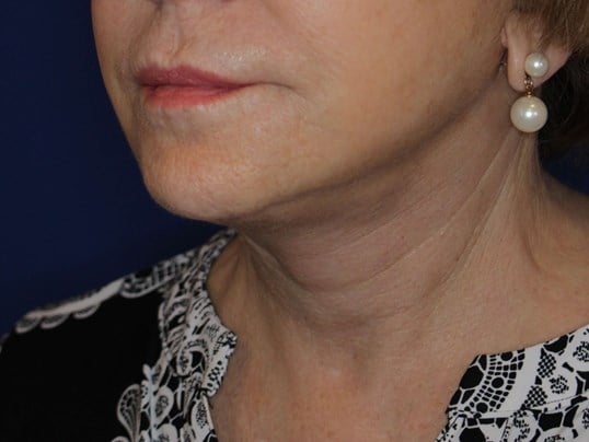 Secondary Neck Lift After